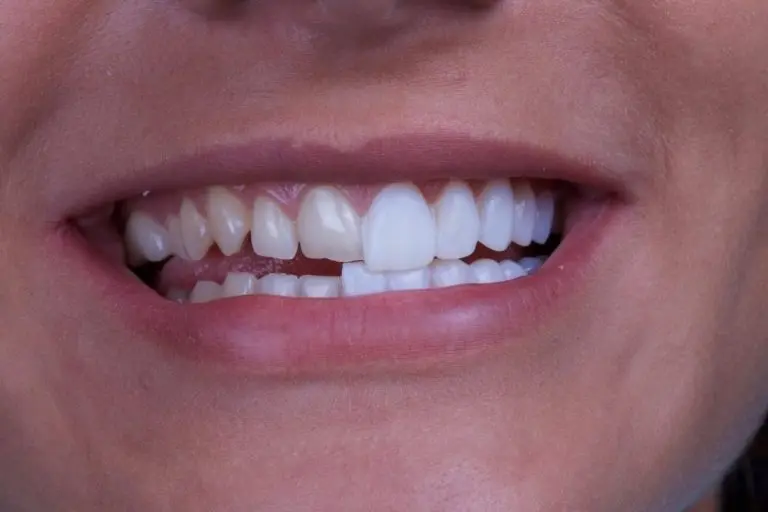 Veneers – perfektes Lächeln durch Keramikschalen